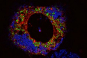 The cells engorged with fats (blue) secrete aP2 at high levels resulting in development of diabetes. Photo: Ana Paula Arruda