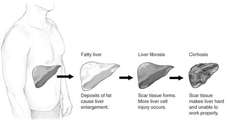 Pioglitazone (Actos) Helps Reverse Fatty liver in Diabetes