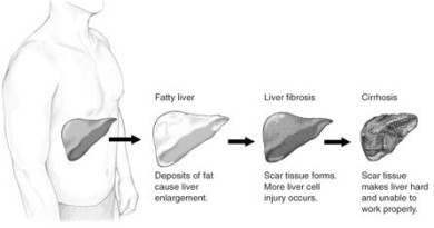 Pioglitazone (Actos) Helps Reverse Fatty liver in Diabetes
