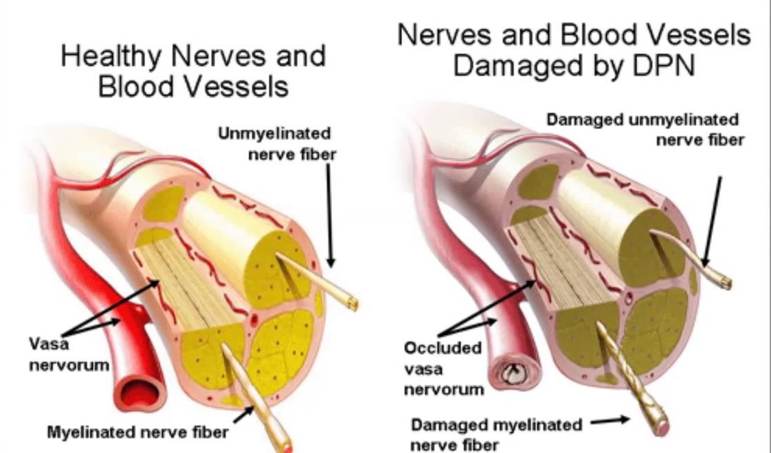 what is diabetic neuropathy caused by